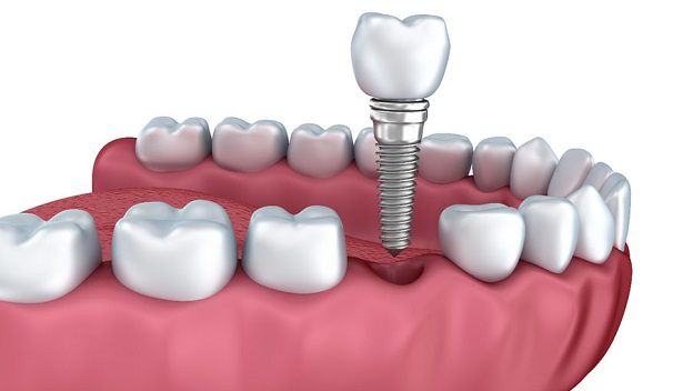 Los implantes dentales y el aumento de la calidad de vida